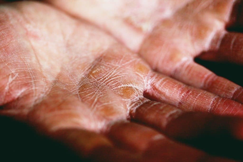 Image of a person with eczema on their hands. Eczema Specialist Brisbane. Brisbane Livewell Clinic