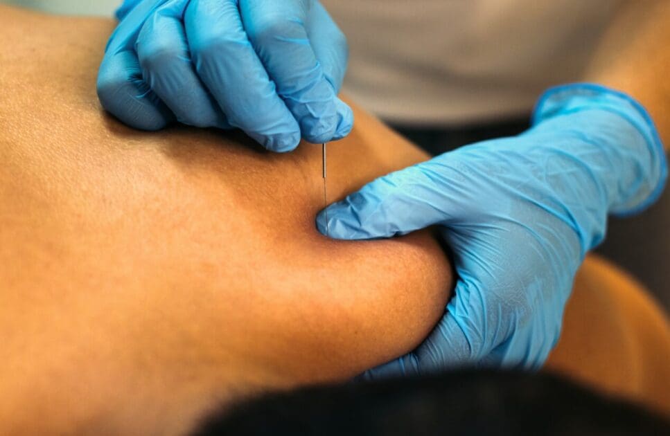Person receiving dry needling session. Dry Needling Near Me. Brisbane Livewell Clinic