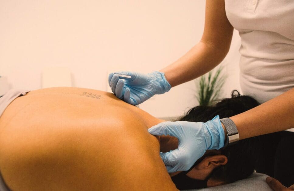 Therapist preparing to insert needles on woman's back. Dry Needling Near Me. Brisbane Livewell Clinic