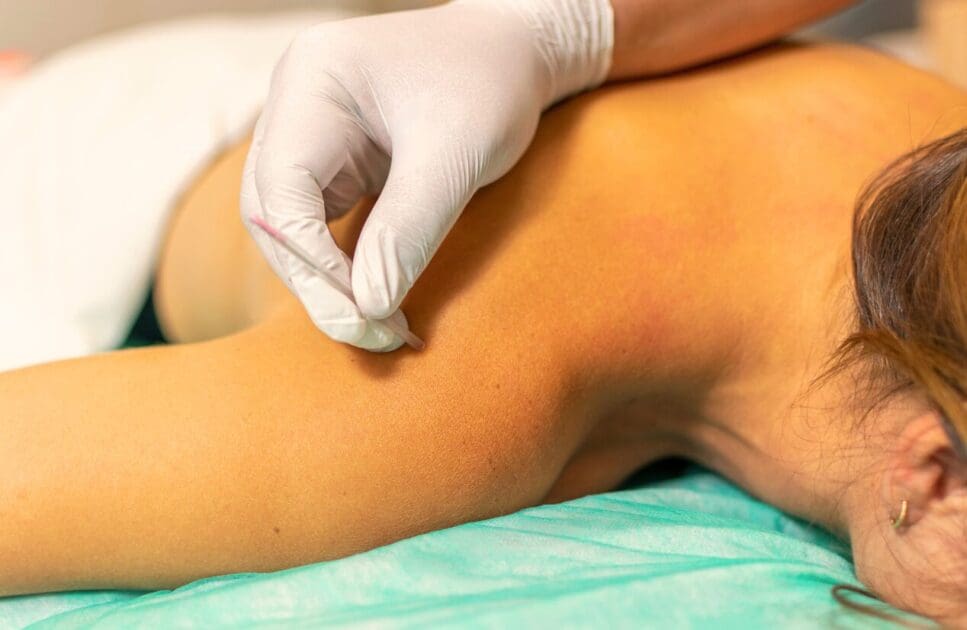 Woman receiving a dry needling treatment. Dry Needling Near Me. Brisbane Livewell Clinic