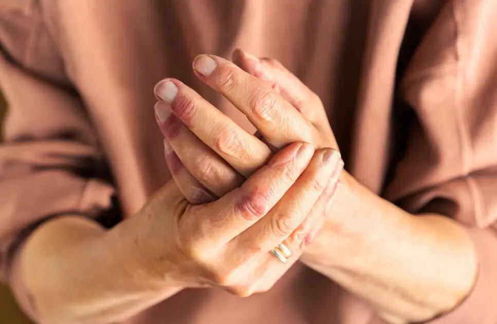 Close-up of a woman's hands with eczema. 4 Simple Ways Acupuncture Helps with Eczema. Eczema Specialist Brisbane. Brisbane Livewell Clinic